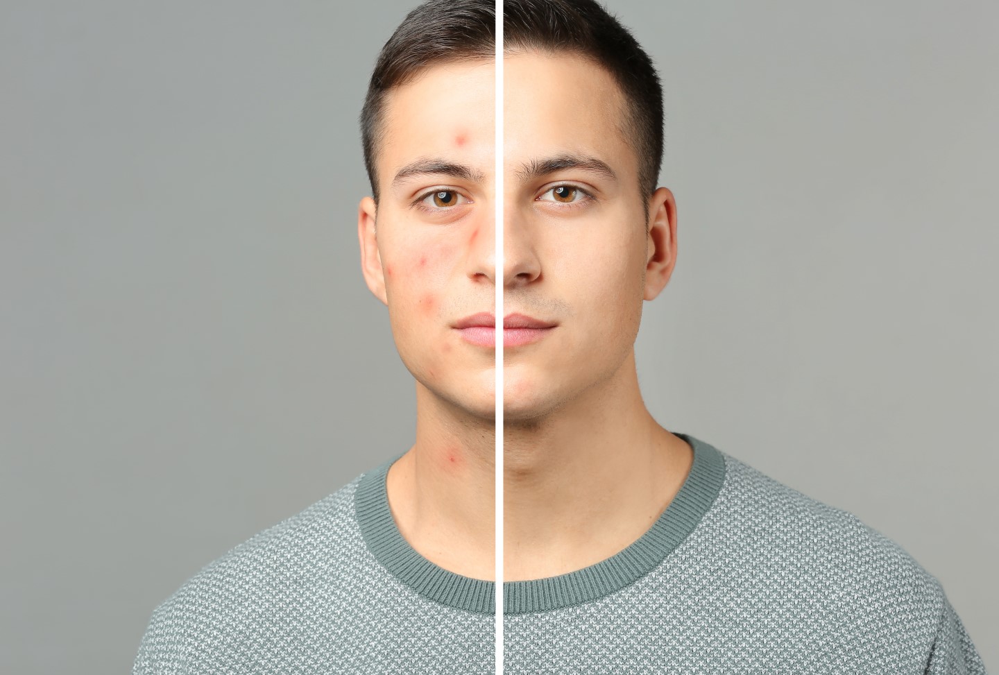 acne-treatments